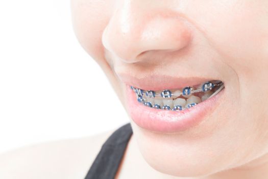 Close up woman smiling with Ceramic and Metal Braces on white background, beauty and healthy concept