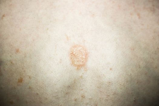 atopic dermatitis. Eczema on the skin of a child. photo for your design
