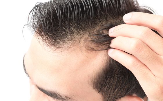 Closeup young man serious hair loss problem for health care shampoo and beauty product concept