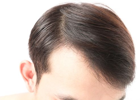 Young man serious hair loss problem for health care shampoo and beauty product concept