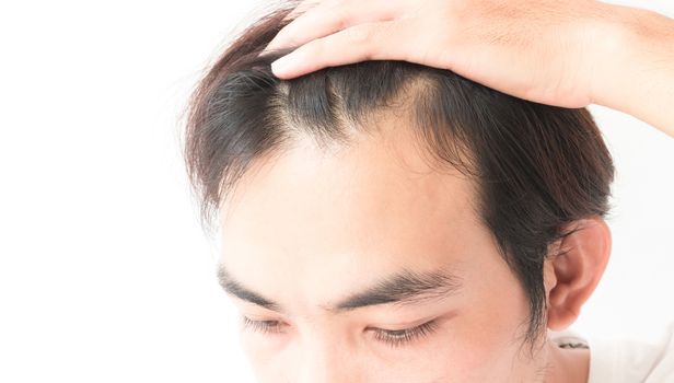 Young man serious hair loss problem for health care shampoo and beauty product concept