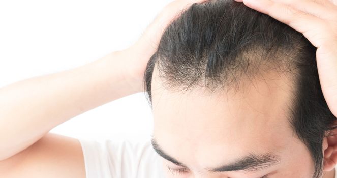 Young man serious hair loss problem for health care shampoo and beauty product concept