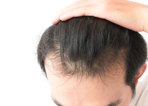 Young man serious hair loss problem for health care shampoo and beauty product concept