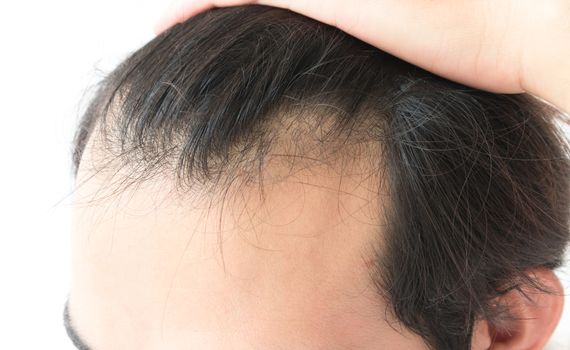 Young man serious hair loss problem for health care shampoo and beauty product concep