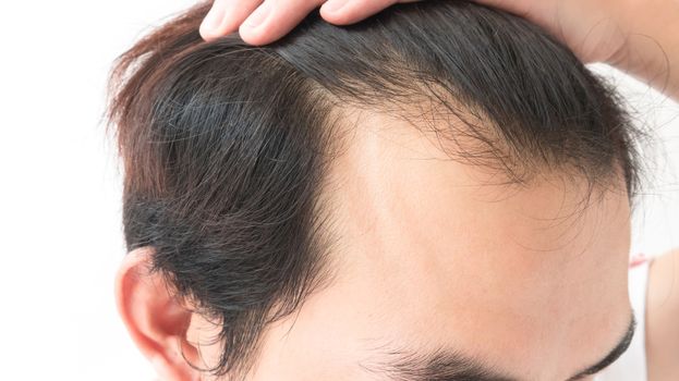 Young man serious hair loss problem for health care shampoo and beauty product concep