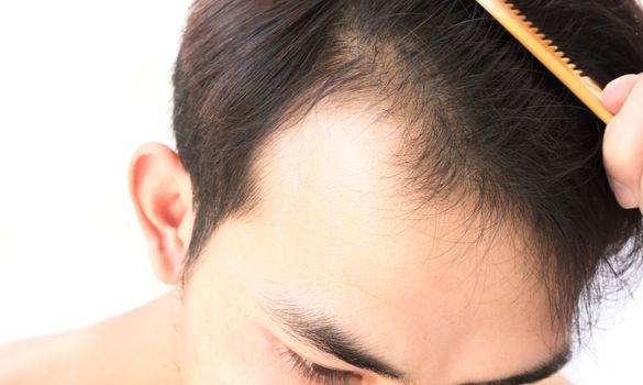 Young man serious hair loss problem for health care shampoo and beauty product concept