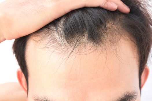 Young man serious hair loss problem for health care shampoo and beauty product concept