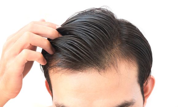 Young man serious hair loss problem for health care shampoo and beauty product concept