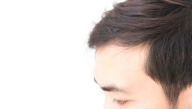 Young man worry hair loss problem for health care shampoo and beauty product concept