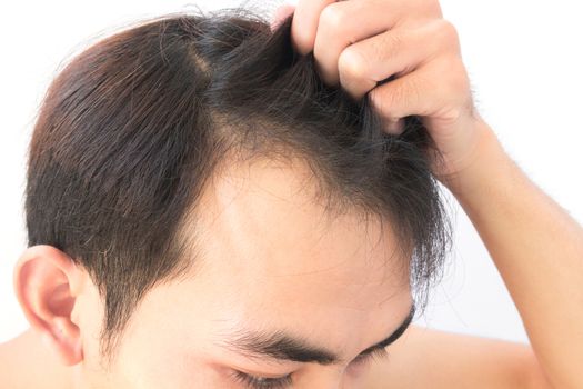 Young man worry hair loss problem for health care shampoo and beauty product concept