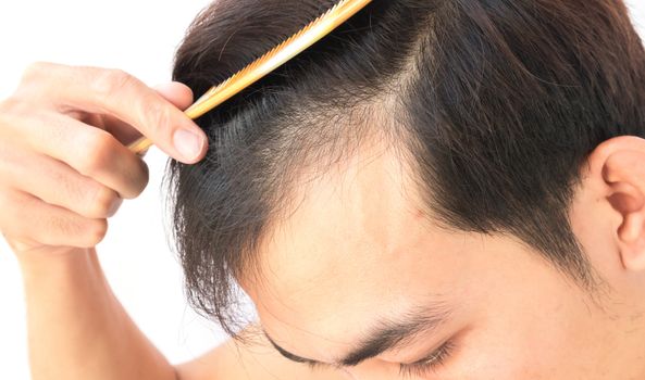 Young man worry hair loss problem for health care shampoo and beauty product concept