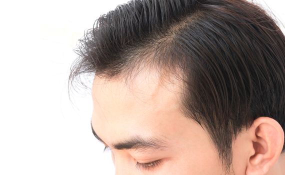 Young man worry hair loss problem for health care shampoo and beauty product concept