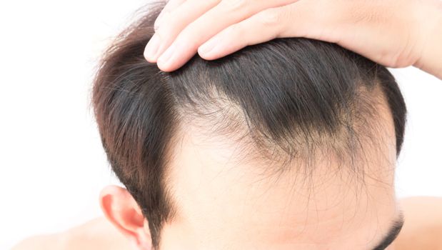 Young man worry hair loss problem for health care shampoo and beauty product concept