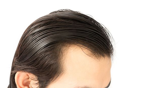 Closeup young man serious hair loss problem for health care shampoo and beauty product concept