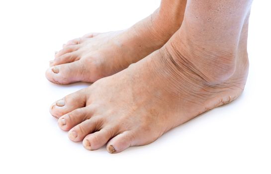 Closeup woman cracked feet and heels with white background, healthy concept