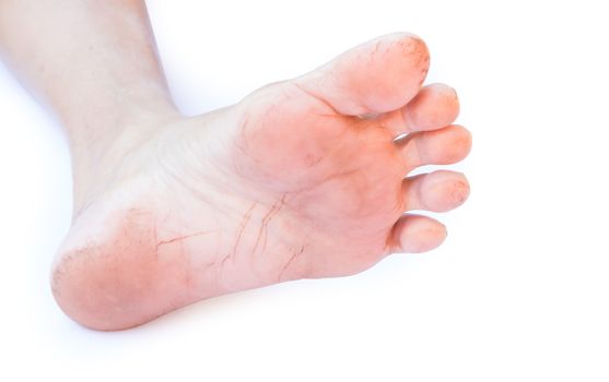 Woman cracked heels with white background, foot healthy concept