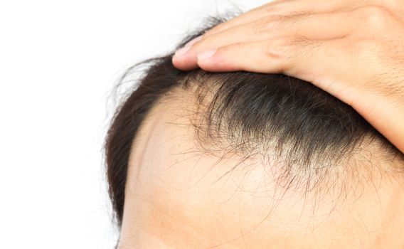 Closeup young man serious hair loss problem for hair loss concept