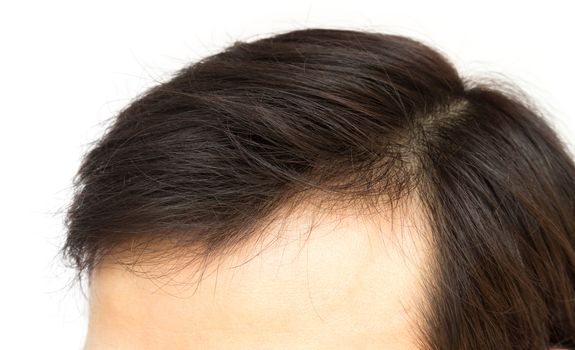 Closeup young man serious hair loss problem for hair loss concept