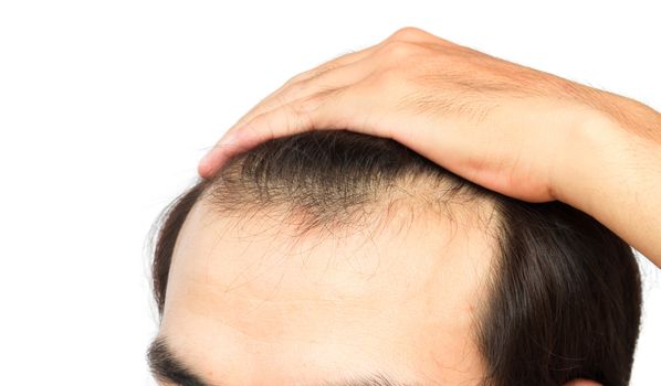 Young man serious hair loss problem for health care shampoo and beauty product concept