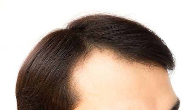 Young man serious hair loss problem for health care shampoo and beauty product concept