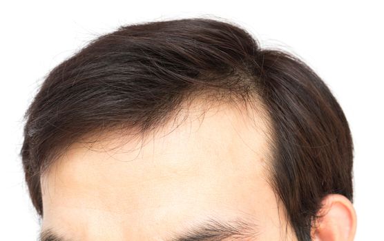 Young man serious hair loss problem for health care shampoo and beauty product concept