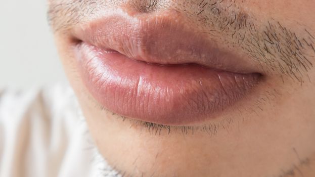 Closeup of lips man problem health care, Herpes simplex