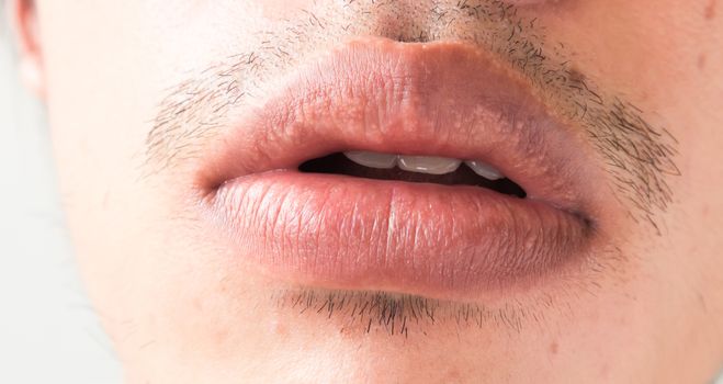 Closeup of lips man problem health care, Herpes simplex