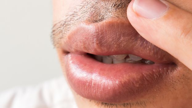 Closeup of lips man problem health care, Herpes simplex