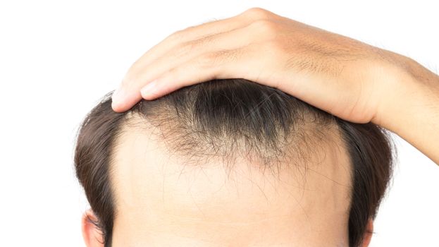 Young man serious hair loss problem for health care shampoo and beauty product concept