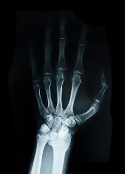 Carpal bones Human X Ray on black.