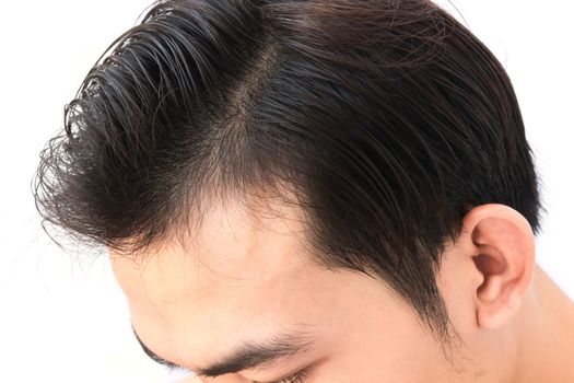 Young man worry hair loss problem for health care shampoo and beauty product concept