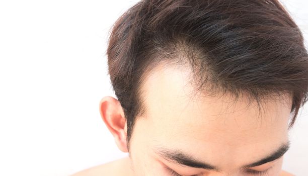 Young man worry hair loss problem for health care shampoo and beauty product concept