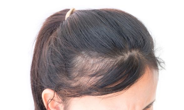 Woman serious hair loss problem for health care shampoo and beauty product concept