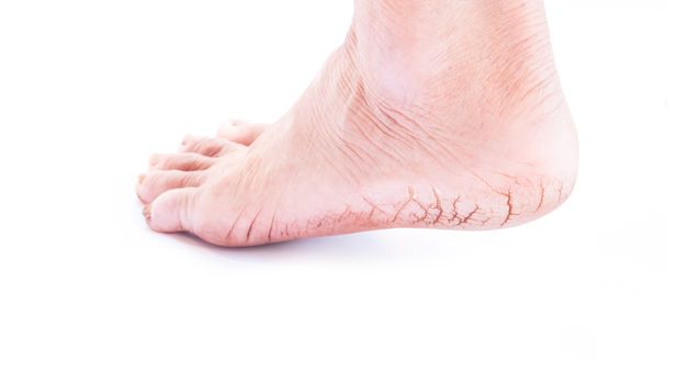 Woman cracked heels with white background, foot healthy concept