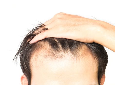 Closeup young man serious hair loss problem for hair loss concept