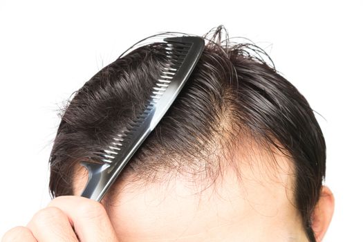 Closeup young man serious hair loss problem for hair loss concept