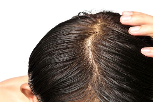 Closeup young man serious hair loss problem for hair loss concept