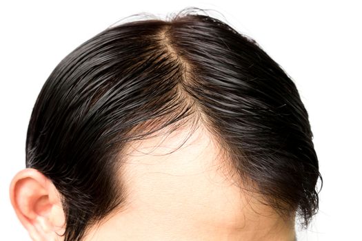 Closeup young man serious hair loss problem for hair loss concept