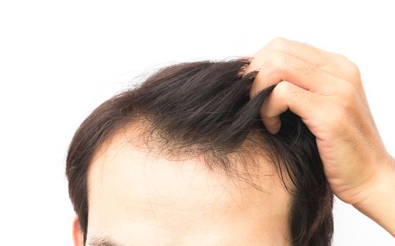 Closeup young man serious hair loss problem for hair loss concept