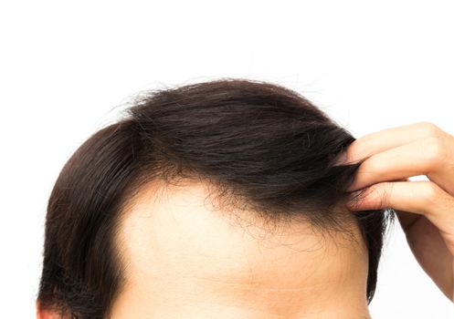 Closeup young man serious hair loss problem for hair loss concept