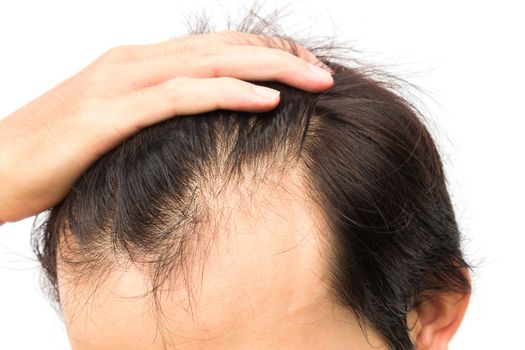 Closeup young man serious hair loss problem for hair loss concept