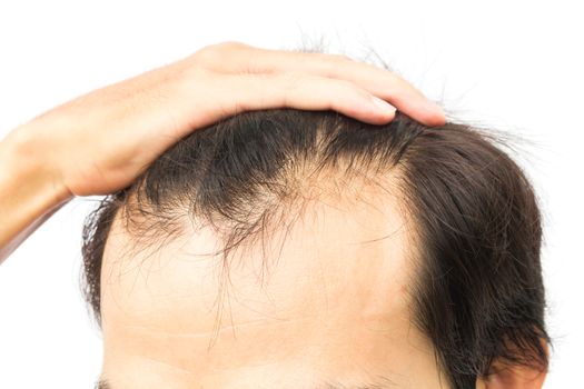 Closeup young man serious hair loss problem for hair loss concept