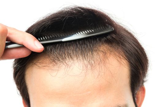 Closeup young man serious hair loss problem for hair loss concept