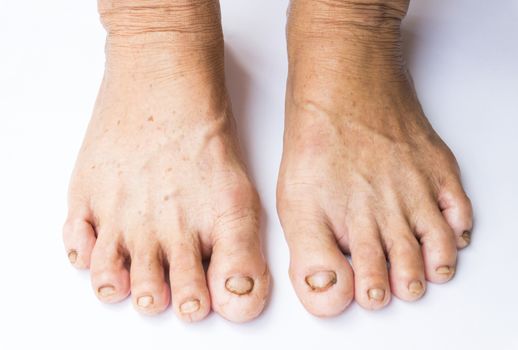 Closeup woman cracked feet and heels on white background, healthy concept