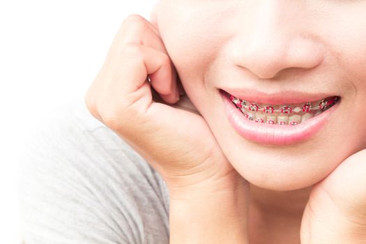 Close up woman smiling with Ceramic and Metal Braces on white background, beauty and healthy concept