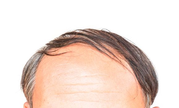 Closeup old man serious hair loss and grey hair problem with white background, hair loss concept