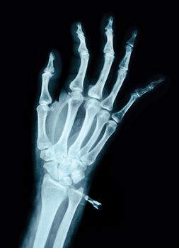 Human Left hand on device x ray - Medical Image