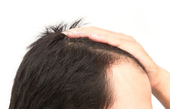 Young man serious hair loss problem for hair loss concept