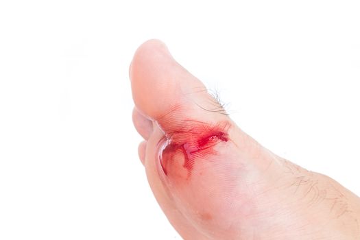 Injured foot, Fresh wound and blood from broken glass, white background