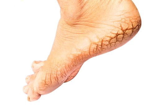 Woman cracked heels with white background, foot healthy concept